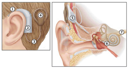 what-is-a-cochlear-implant.0ed7861247.png